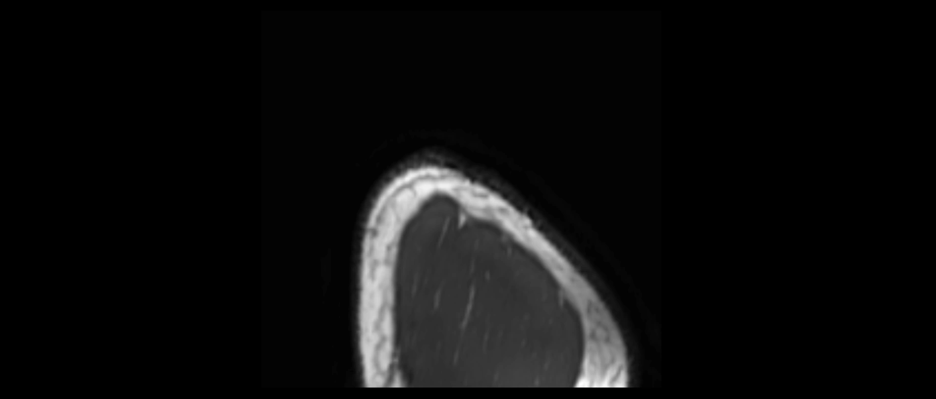 shoulder ligaments sagittal  cross sectional anatomy 3T MRI AI enhanced radiology image -img-00001-00065.webp